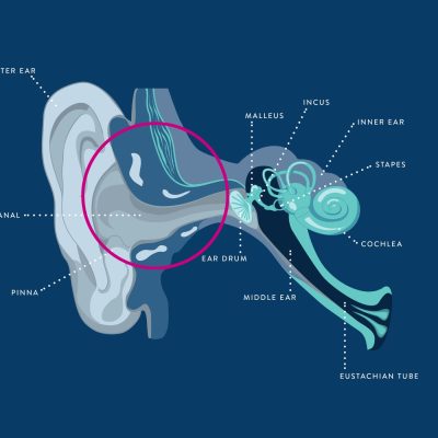 Diagram of an ear illustrating the origin of conductive hearing loss.