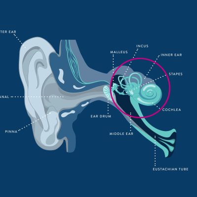 Diagram of an ear illustrating the origin of sensorineural hearing loss, highlighting the inner ear structures involved.