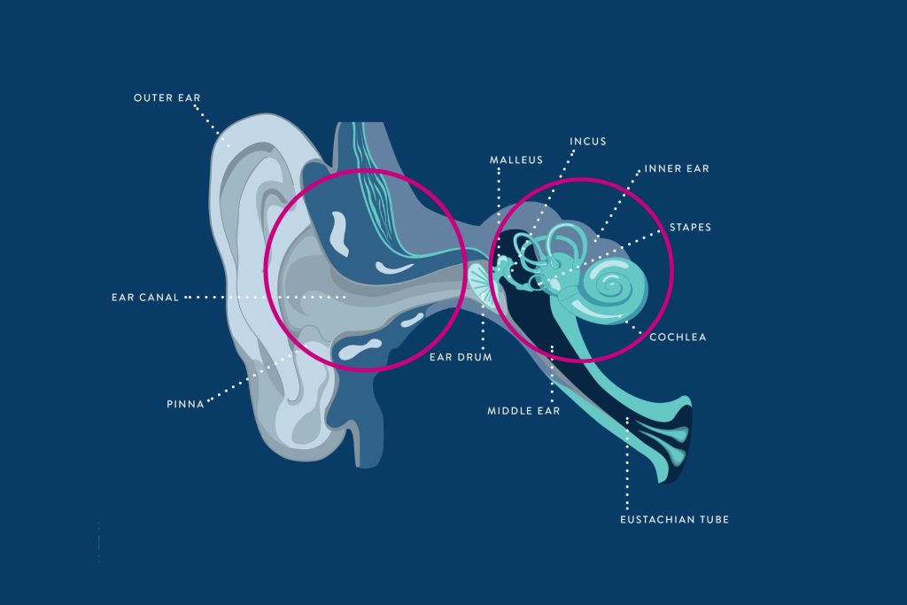 Diagram of an ear illustrating the origin of mixed hearing loss, highlighting both conductive and sensorineural pathways.