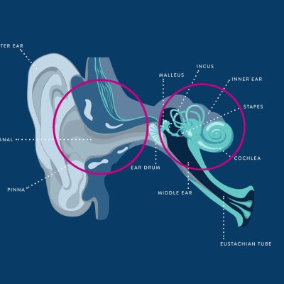 Diagram of an ear illustrating the origin of mixed hearing loss, highlighting both conductive and sensorineural pathways.