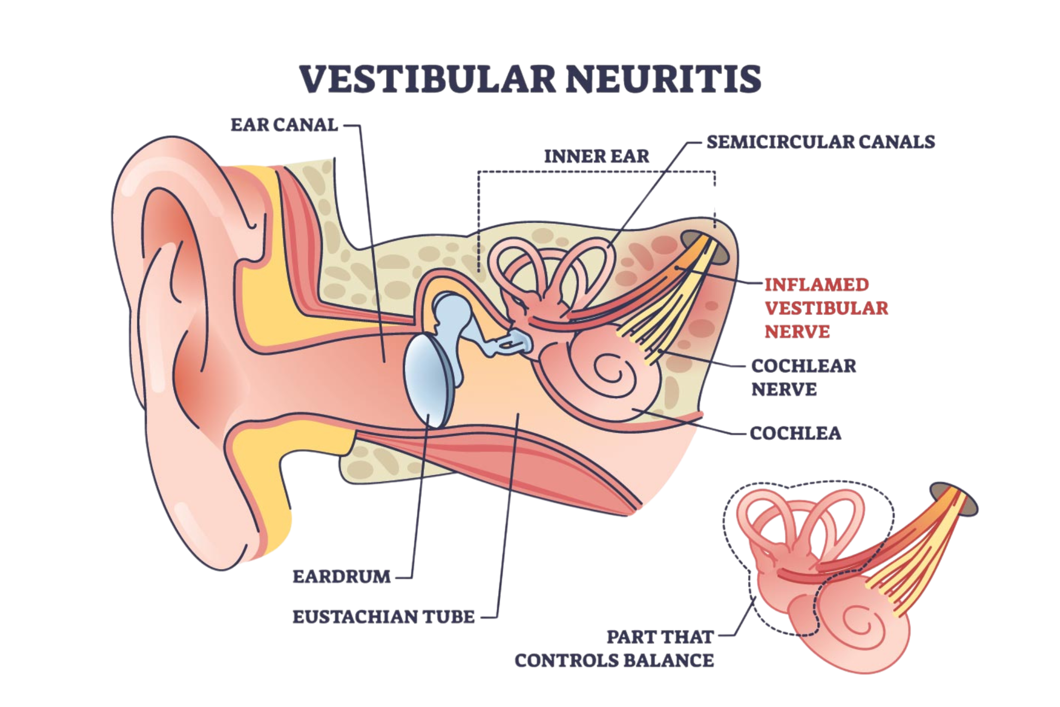 vestibular neuritis diagram